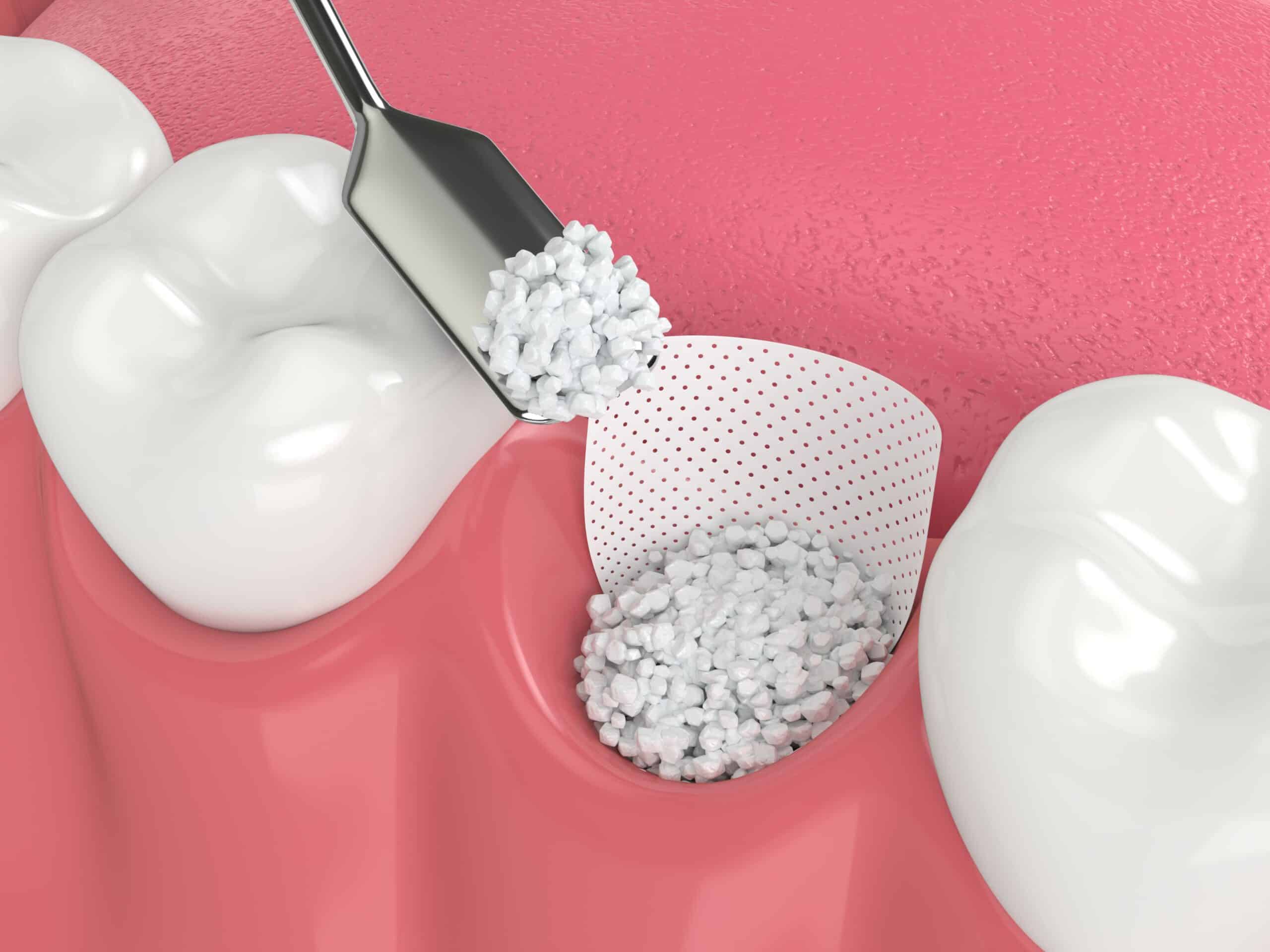 Bone grafting Cambridge