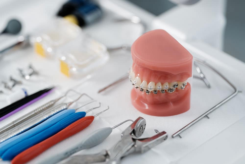 Braces with metal wires Cambridge