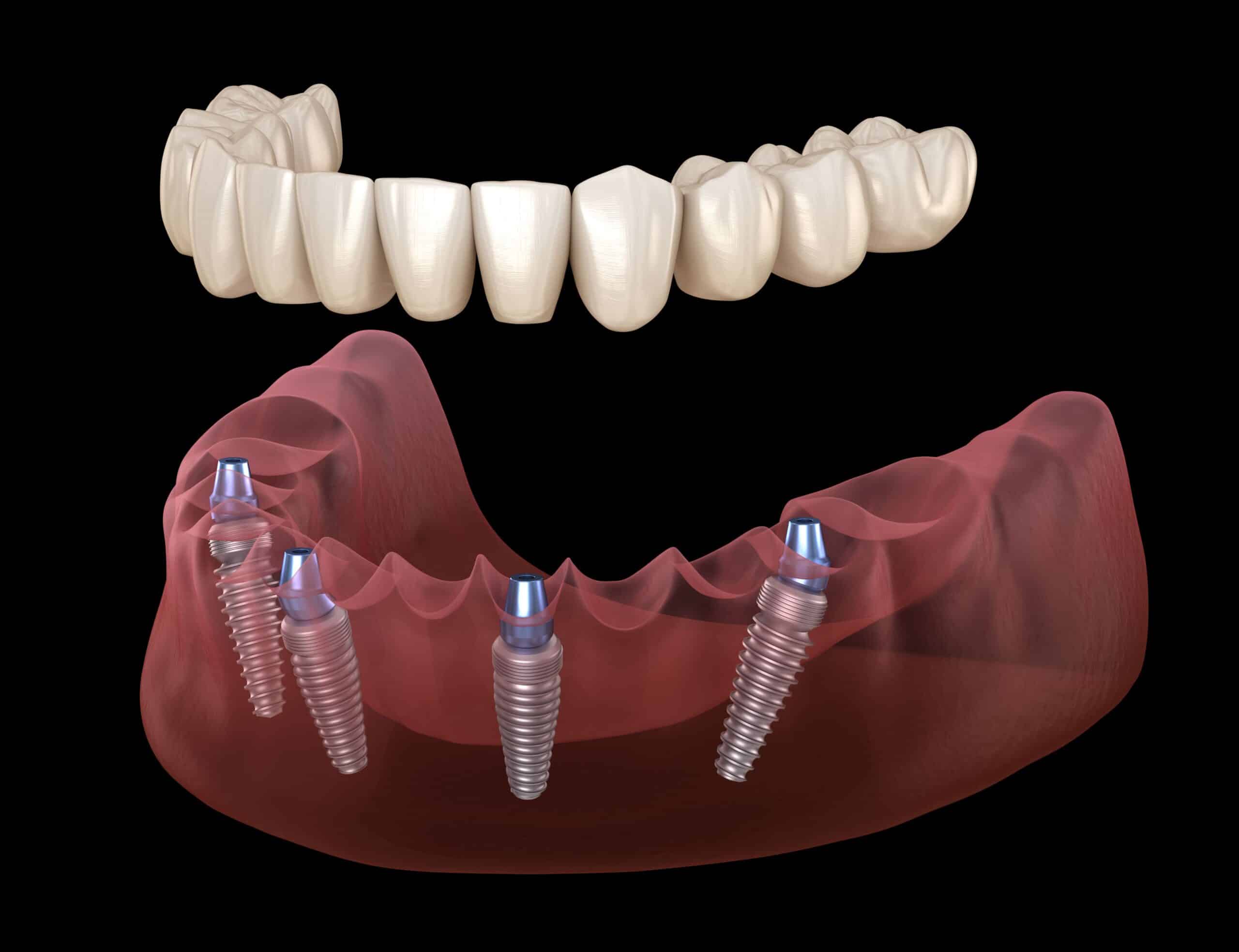 Same-day dental implants Cambridge
