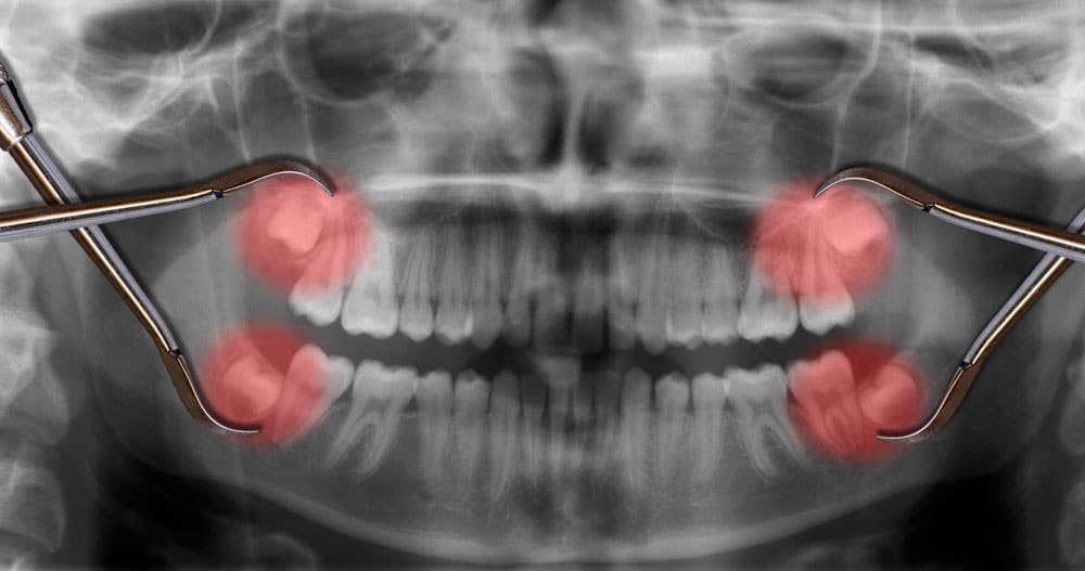 Wisdom Teeth Extraction Cambridge