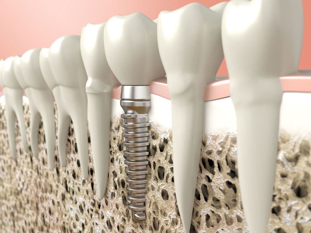Mini implant clinic Cambridge