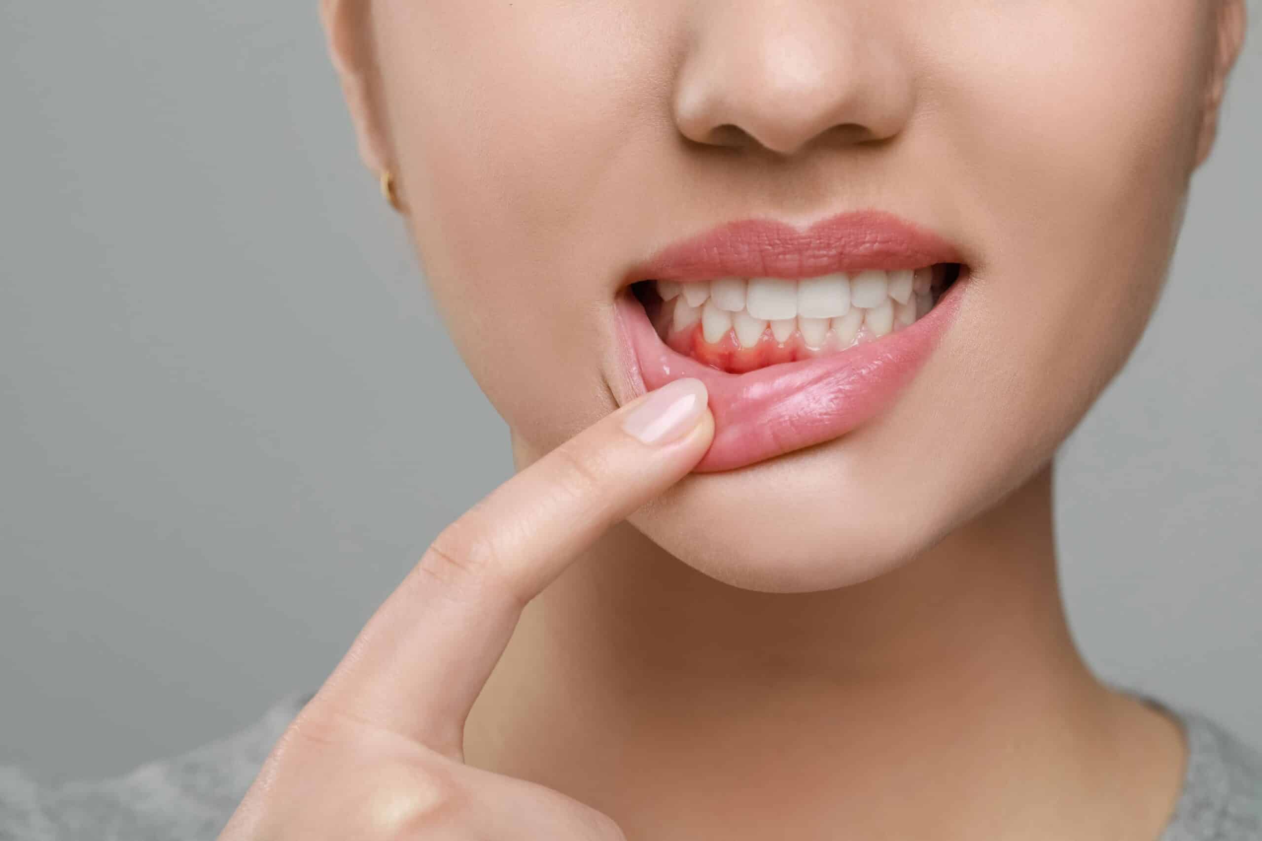 Gum infection treatment Cambridge