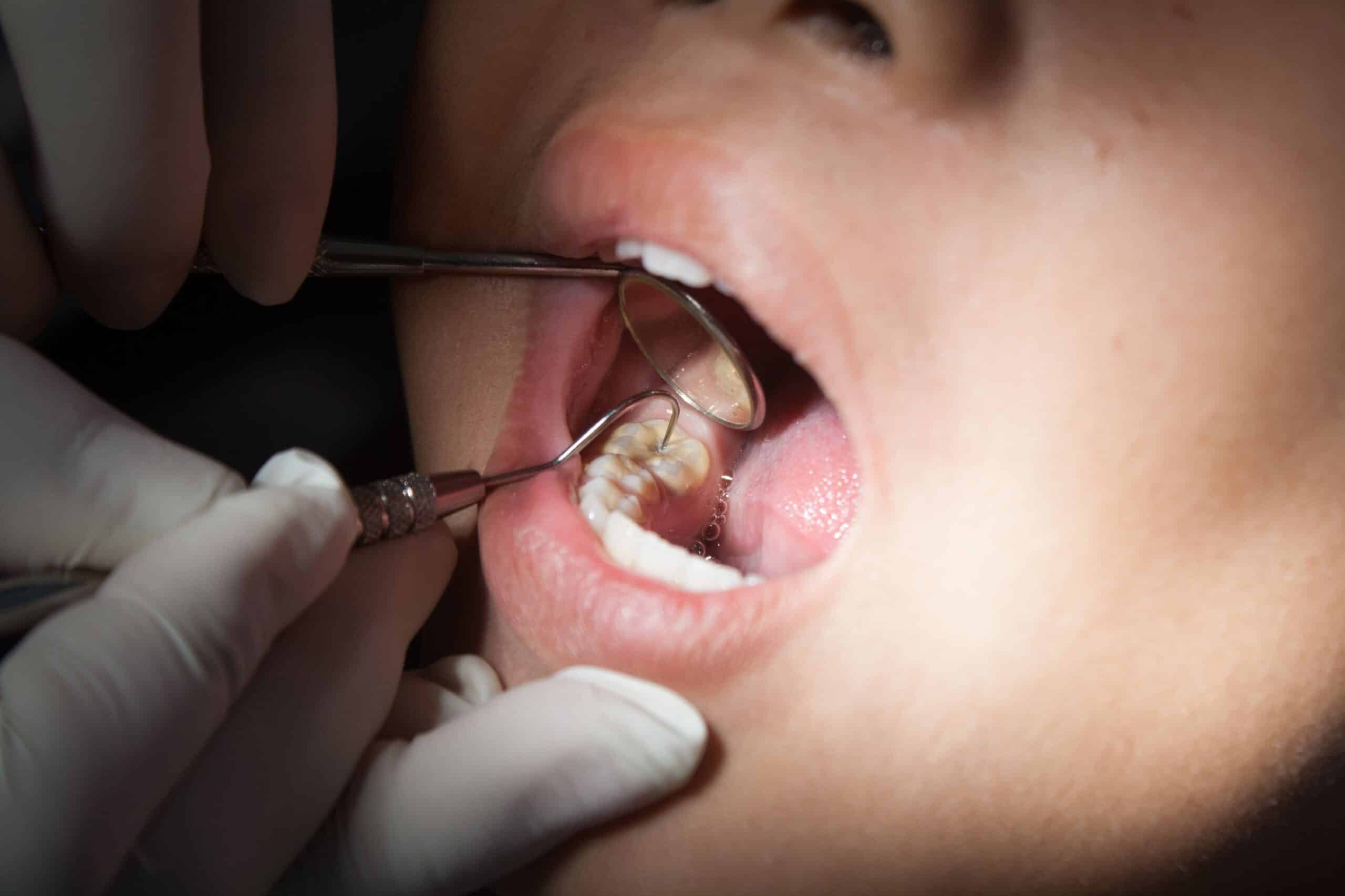 Sealants for teeth Cambridge