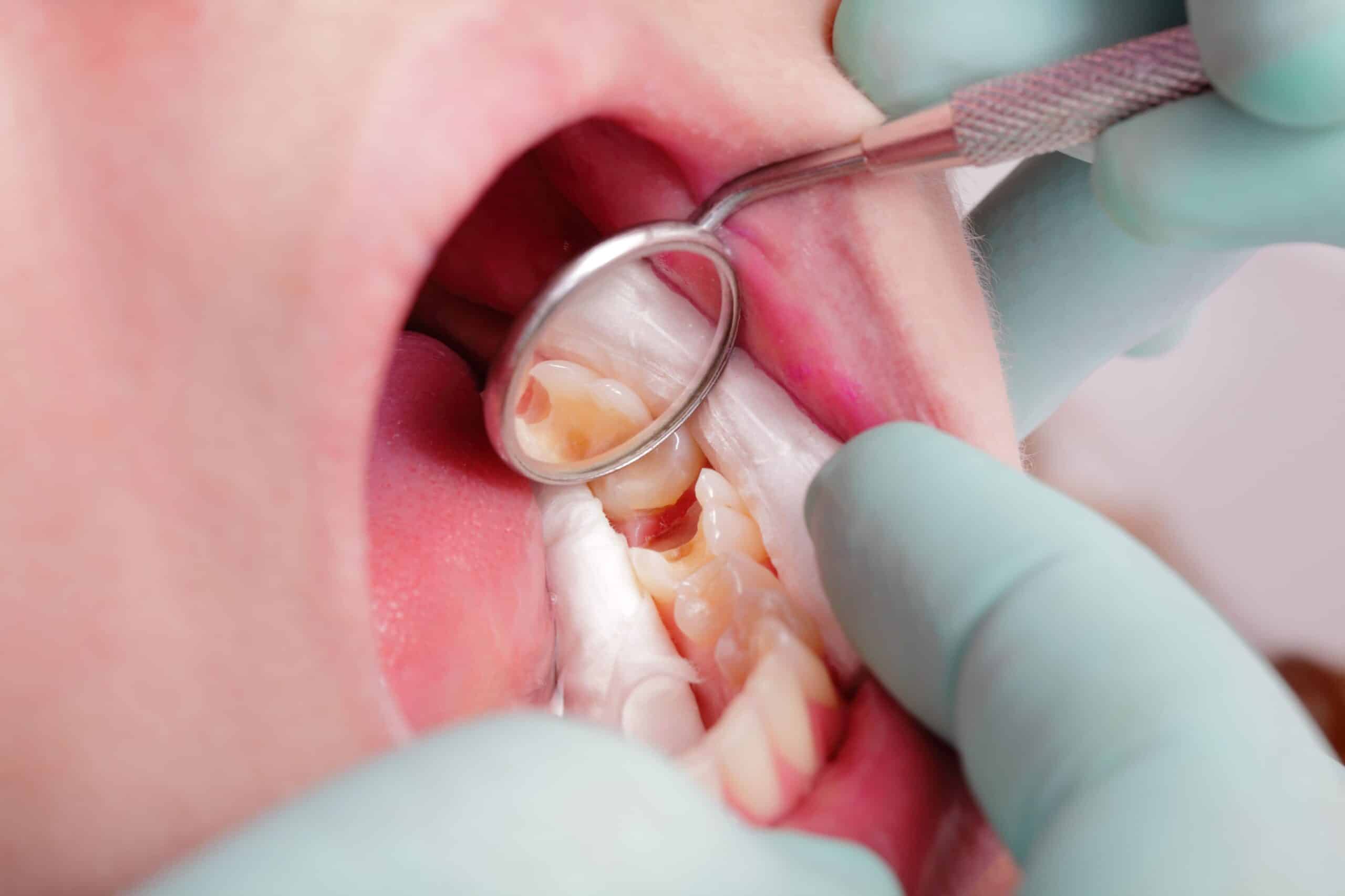 Early tooth decay detection