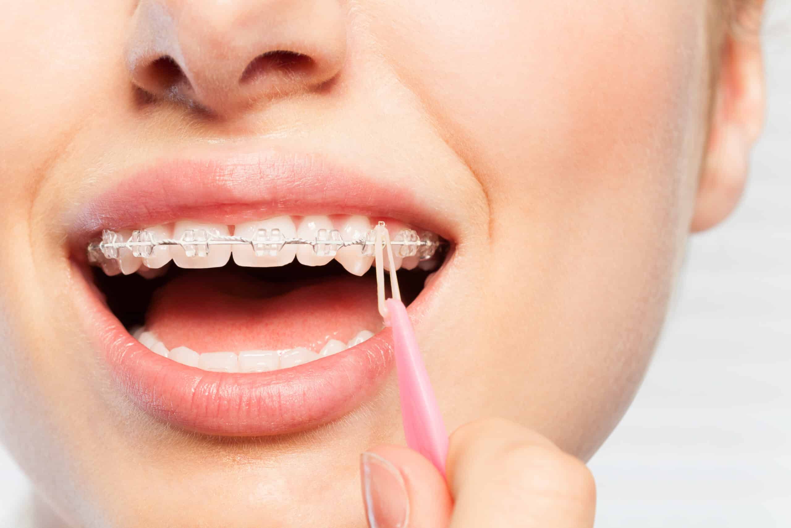 Invisible braces Cambridge, Ontario