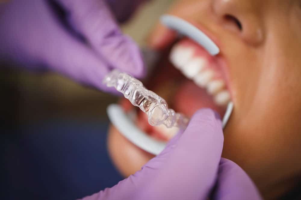 Invisalign dentist Cambridge