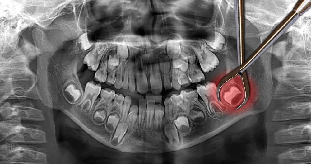 Tooth extraction Cambridge