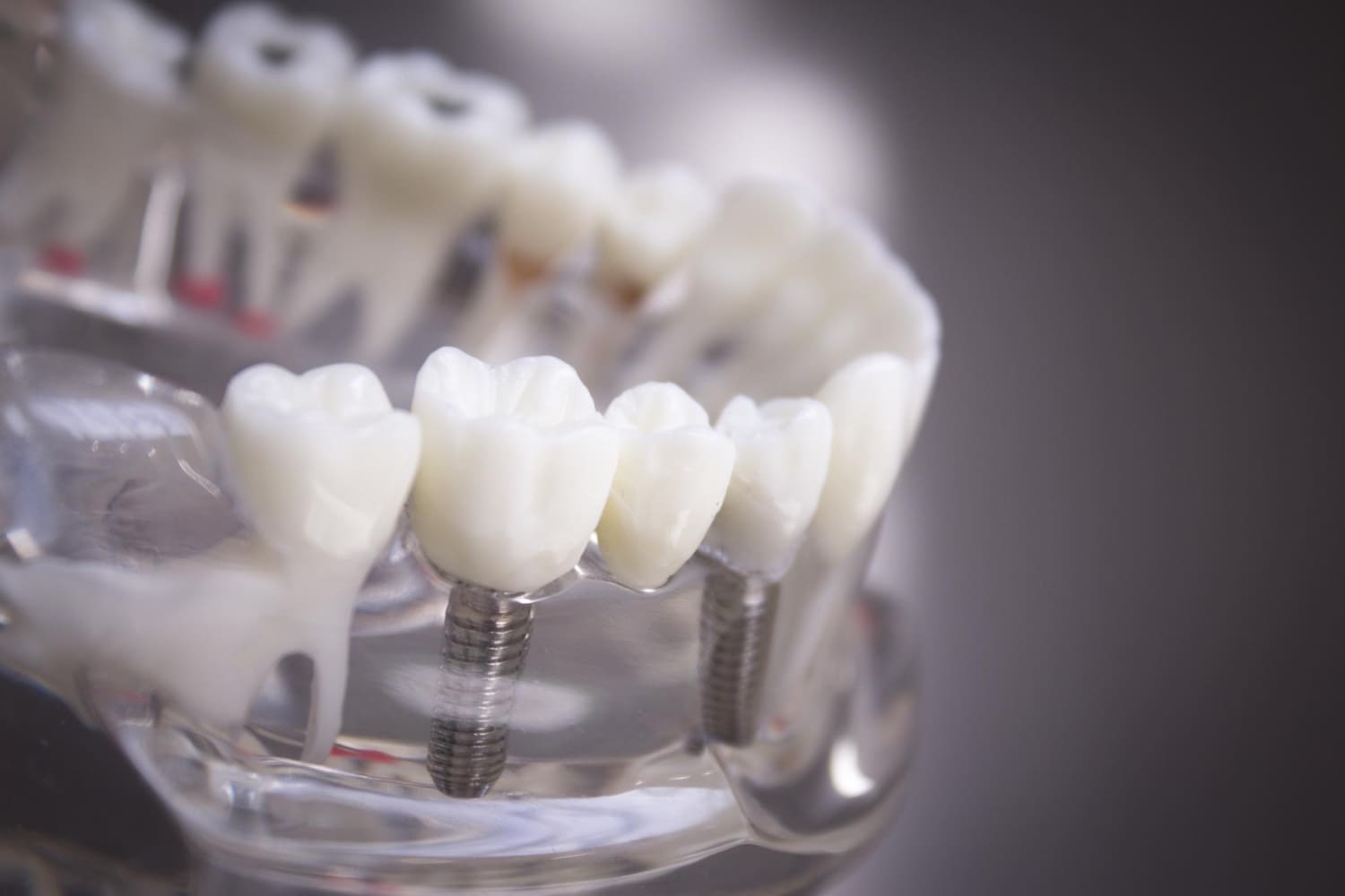 Crown exposure procedure Cambridge