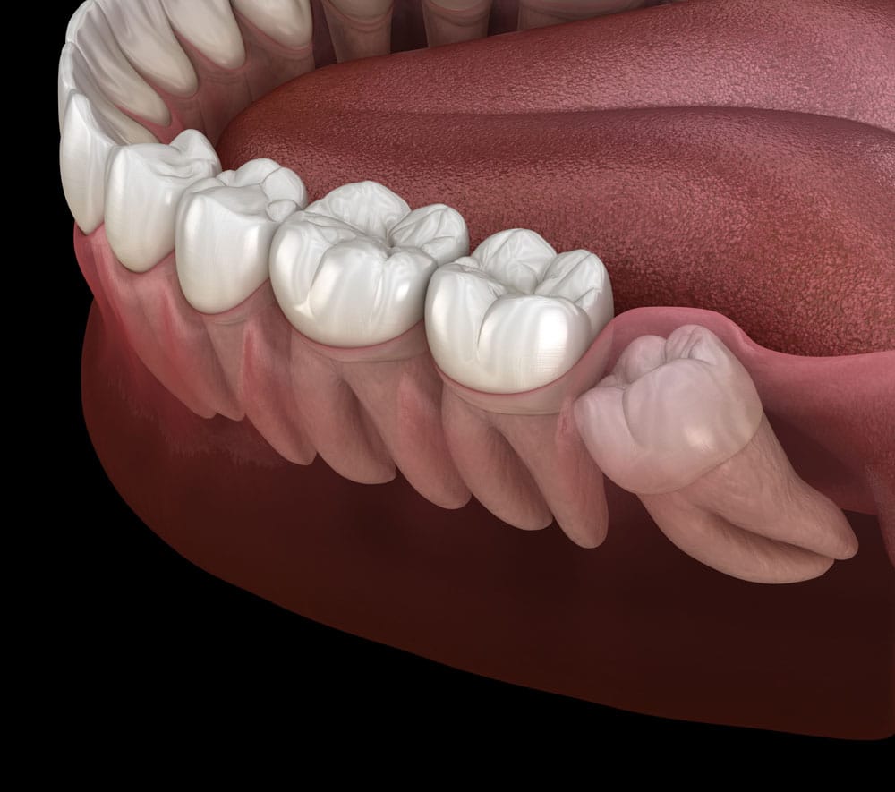 Dental surgery for wisdom teeth Cambridge