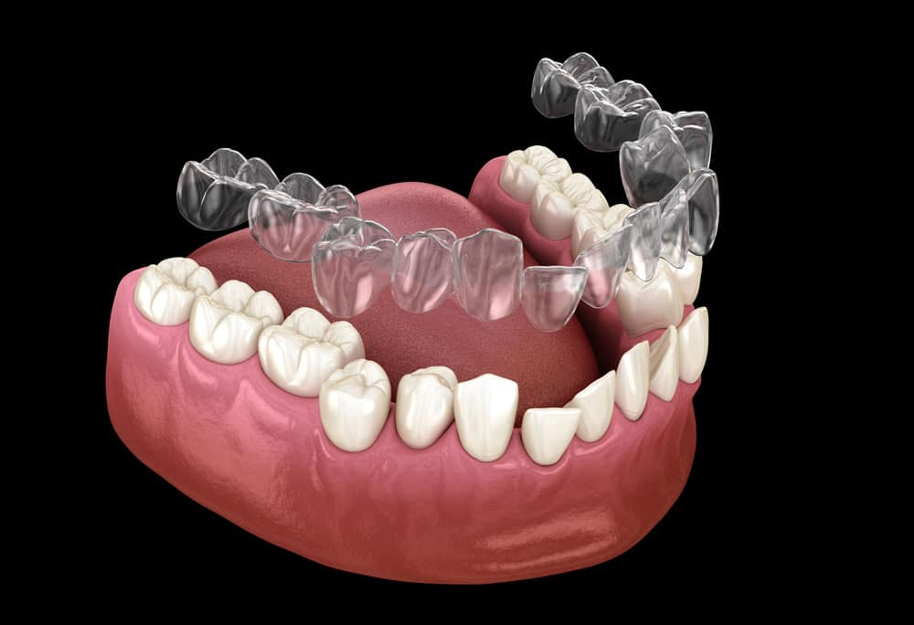 Invisalign Cambridge