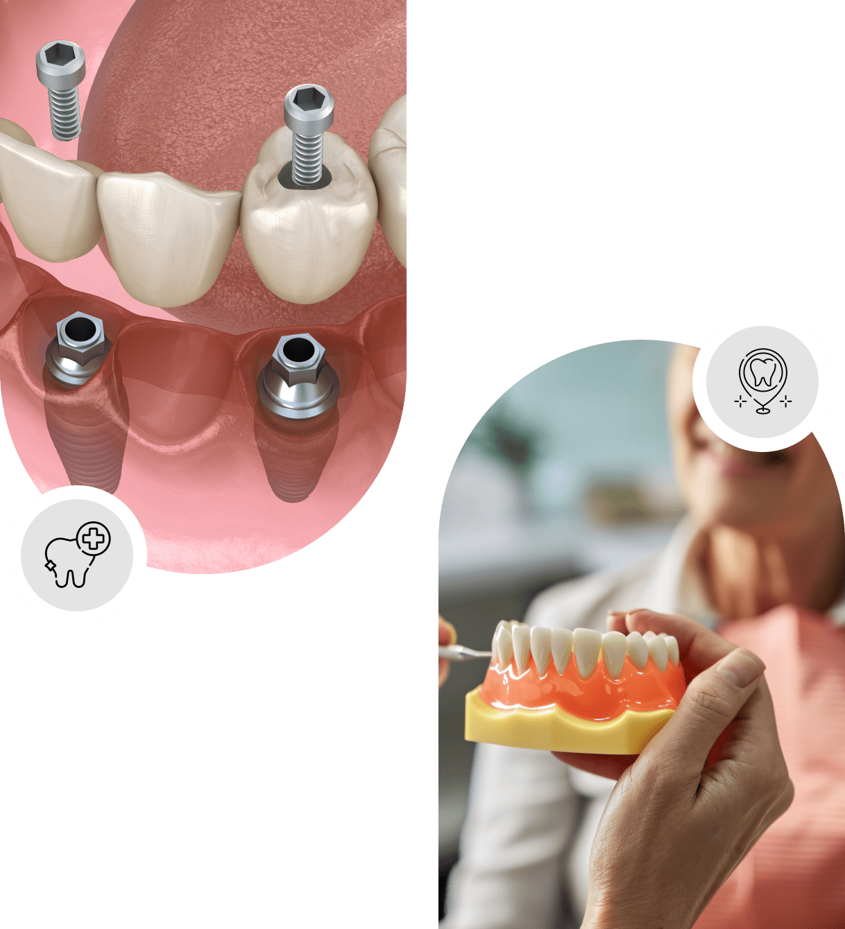 All-on-4 implant dentist Cambridge