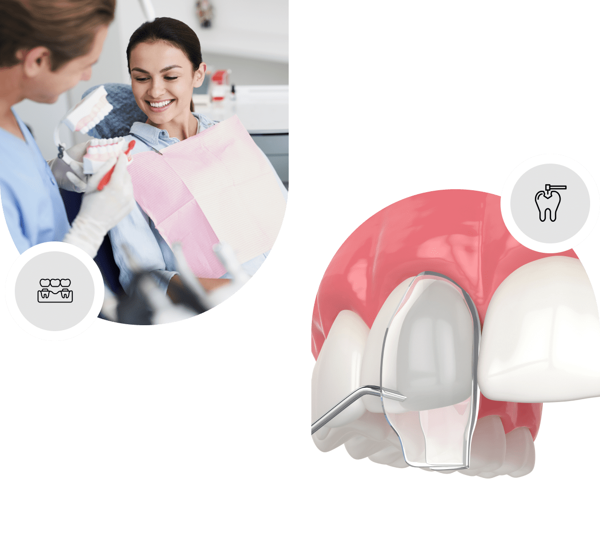 Dental bonding Cambridge