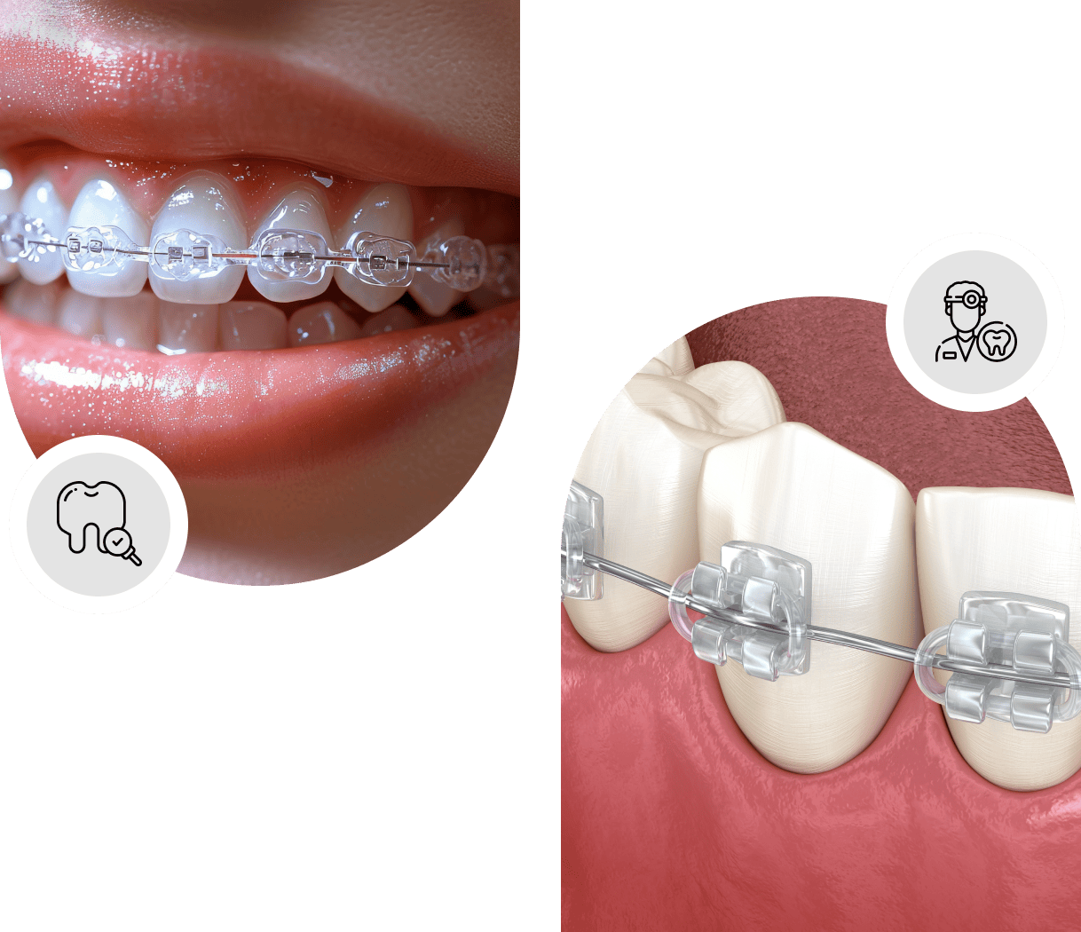 Invisible braces Cambridge