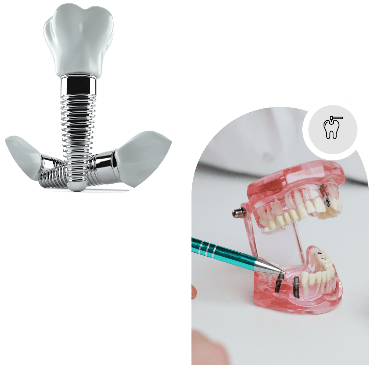 Mini dental implants Cambridge