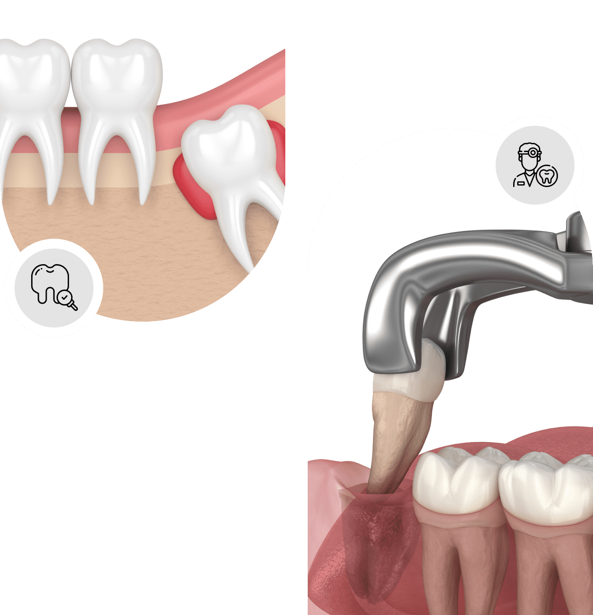 Wisdom teeth removal Cambridge