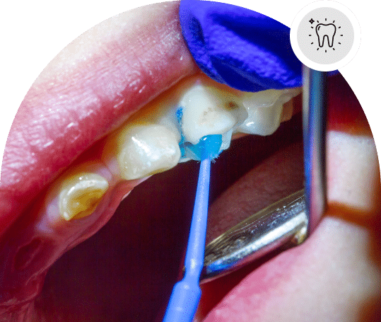 Preventive dental sealants Cambridge